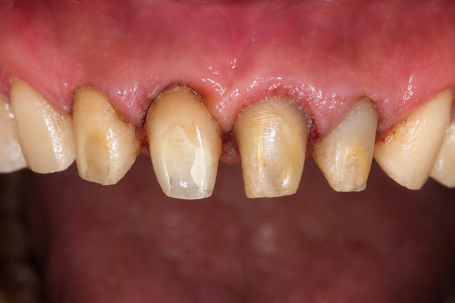 Before treatment