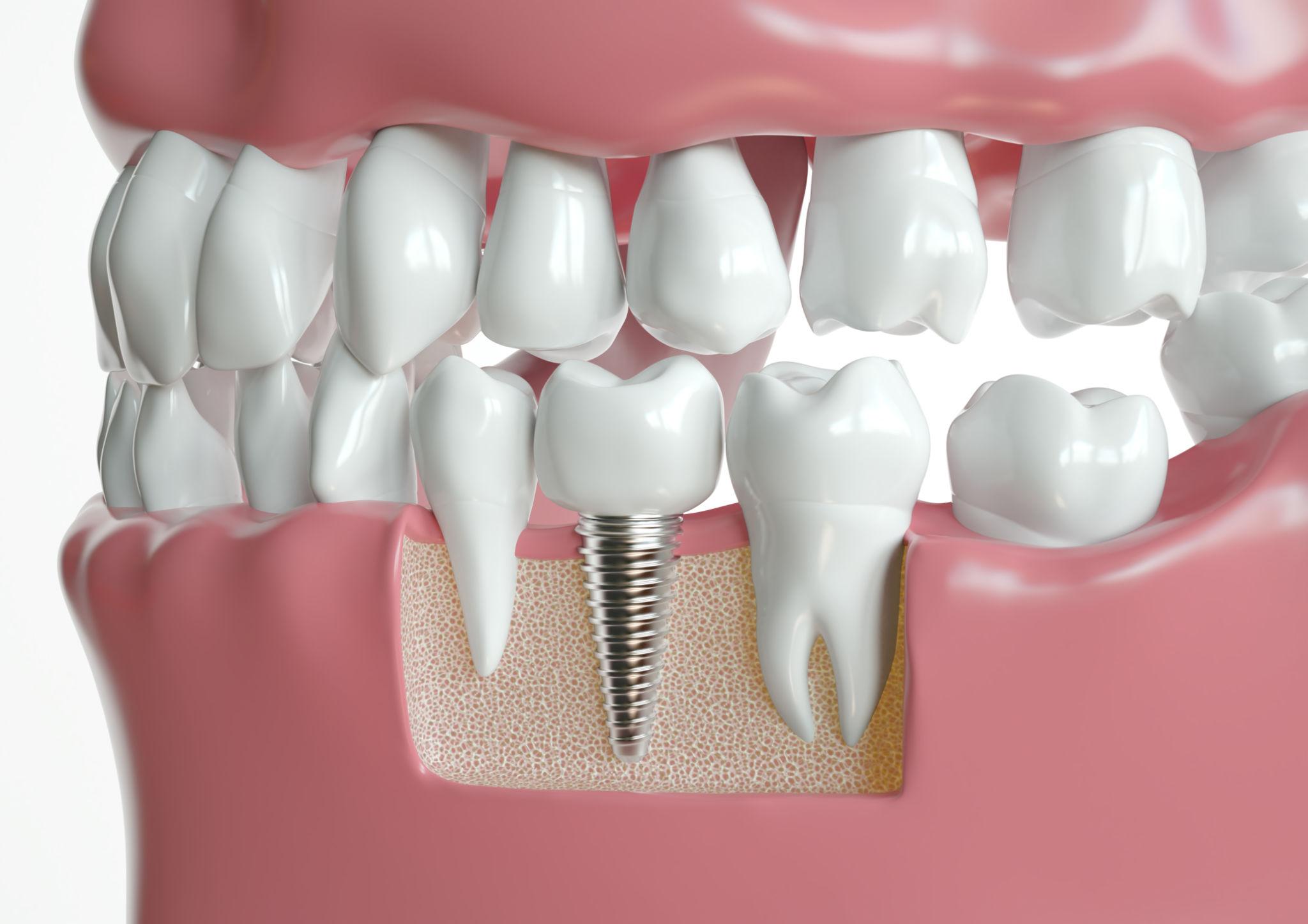 Dental Implants